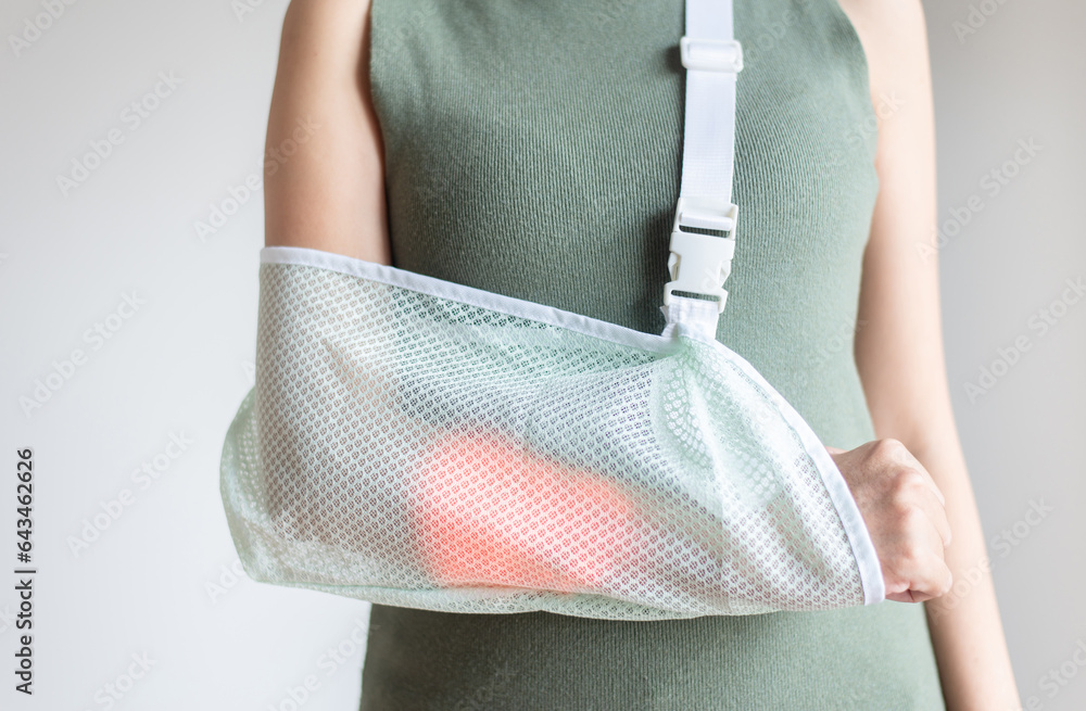 Patient woman wearing arm sling for relieve broken arms on white background Stock Photo Adobe