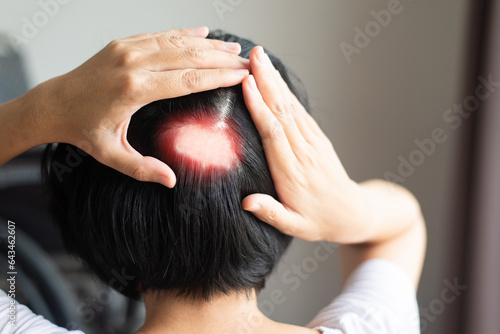 Woman with spot alopecia and areata is an autoimmune disorder