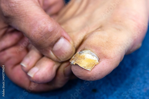 Macro of a human nail with fungal infection. Big toe with advanced onychomycosis.