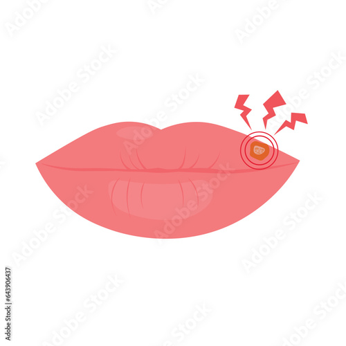 Lips affected by herpes. Vector illustration. Isolated on a white background. A wound on a woman's lips. Packaging of the virus medicine.