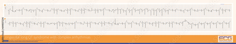 A 4-year-old boy with a clinical diagnosis of long QT syndrome. No genetic testing was done during hospitalization. The child died suddenly during follow-up. A 4-year-old boy with a clinical diagnosis of long QT syndrome. No genetic testing was done during hospitalization. The child died suddenly during follow-up.