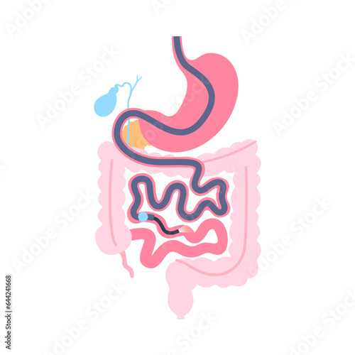 Single balloon enteroscopy