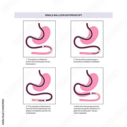 Single balloon enteroscopy