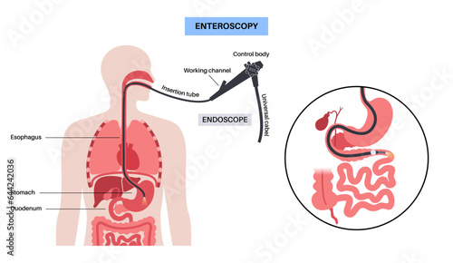 Esophagogastroduodenoscopy medical procedure