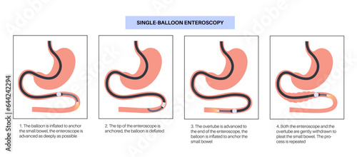 Single balloon enteroscopy