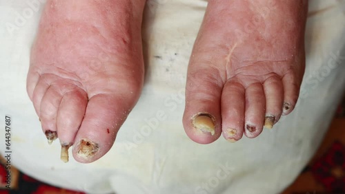 Peeling of the skin on the toes and sore nails in an elderly person. Close-up, hyperkeratosis and dermatosis photo
