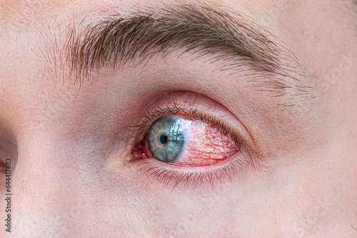 Man with red eye, macro shot. Conjunctivitis infection. concept of eye disease, Allergic conjunctivitis hyperemia photo