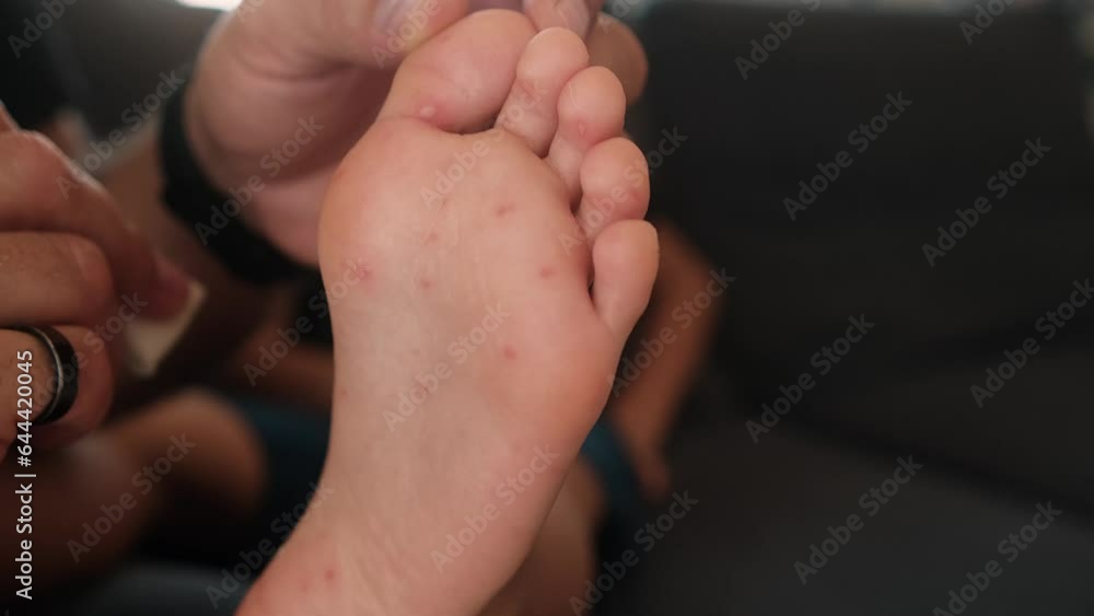 Close up feet of a child with a rash, Coxsackie virus, chickenpox