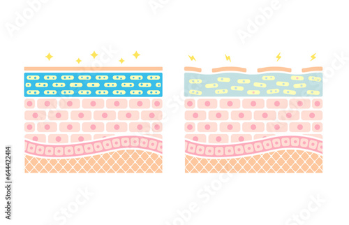 Comparison illustration of healthy skin and dry skin (cross section of skin)