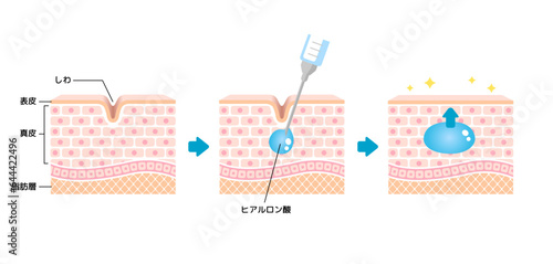 ヒアルロン酸注入によるしわ取り / 仕組み図解イラスト photo