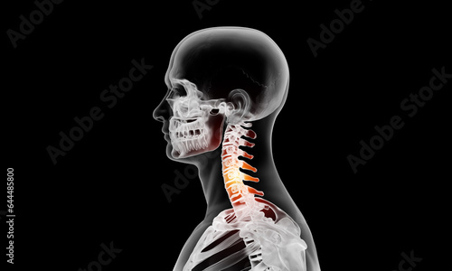 Side view of cervical section of spine injury and pain