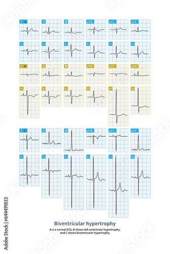 The electrocardiogram of biventricular hypertrophy can be completely normal, with unilateral ventricular hypertrophy or bilateral ventricular hypertrophy simultaneously.