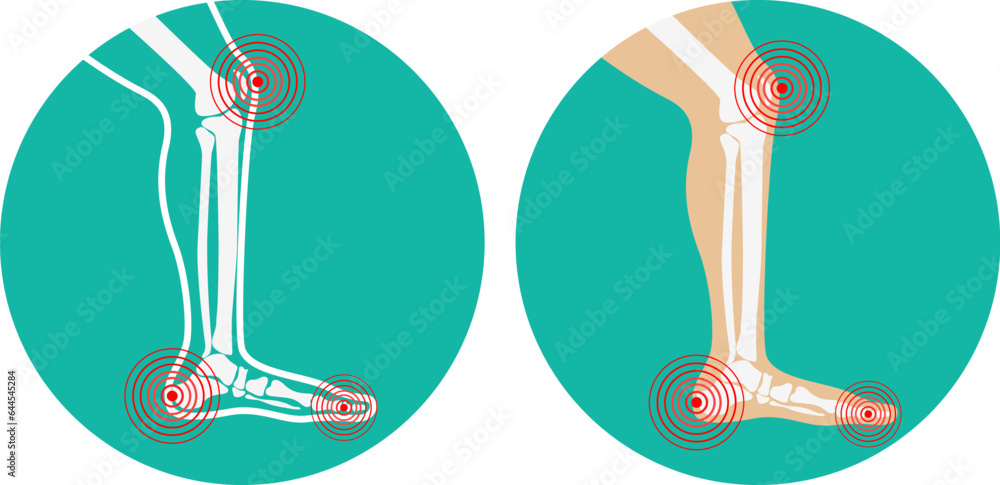 Pain in legs. knee pain, heel pain. Vector illustration. Pain in legs. knee pain, heel pain. Vector illustration.