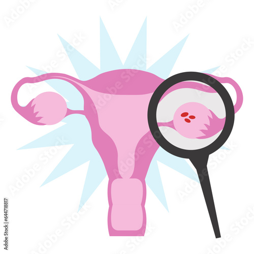 uterus ovaries pcos magnifying glass in flat illustration
