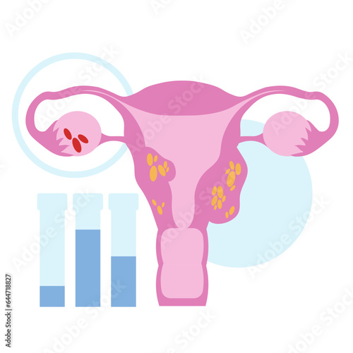 uterus ovaries endometriosis pain in flat illustration