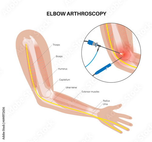 Elbow arthroscopy surgery