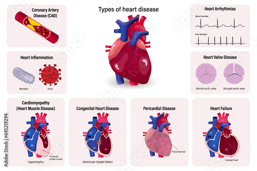 Types of heart disease vector. Coronary Artery
Disease (CAD), Heart Inflammation, Cardiomyopathy, Congenital Heart Disease, Pericarditis, Heart Failure, Heart Valve and Cardiac Arrhythmias. photo