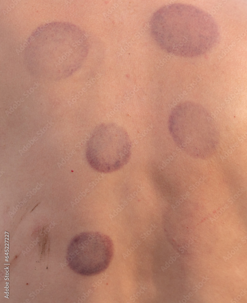 Fototapeta premium Traces from cans on human skin. Medicine