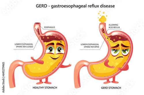 Healthy stomach and gastroesophageal reflux disease cartoon characters