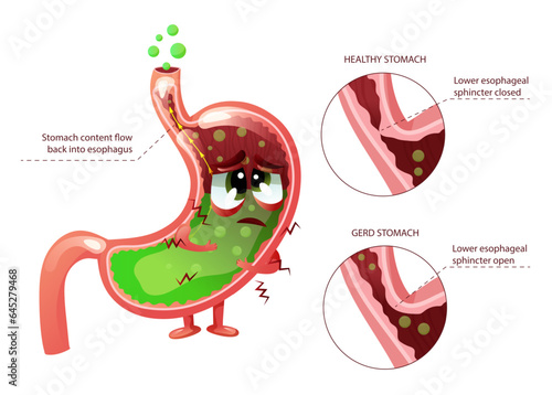 Gastroesophageal reflux disease GERD with stomach cartoon character. Moving gastric juice to esophagus through opened esophageal sphincter, making heartburn. Anatomical vector illustration 