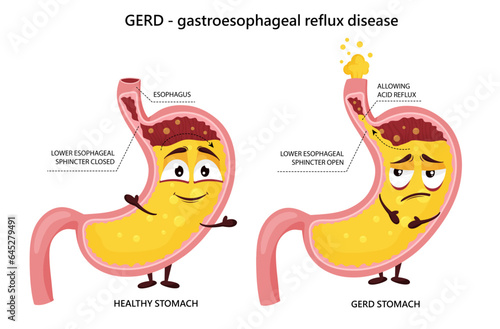 Happy healthy stomach and sad gastroesophageal reflux disease cartoon characters photo