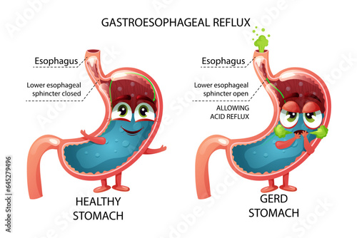 Healthy stomach and sad GERD cartoon stomach characters