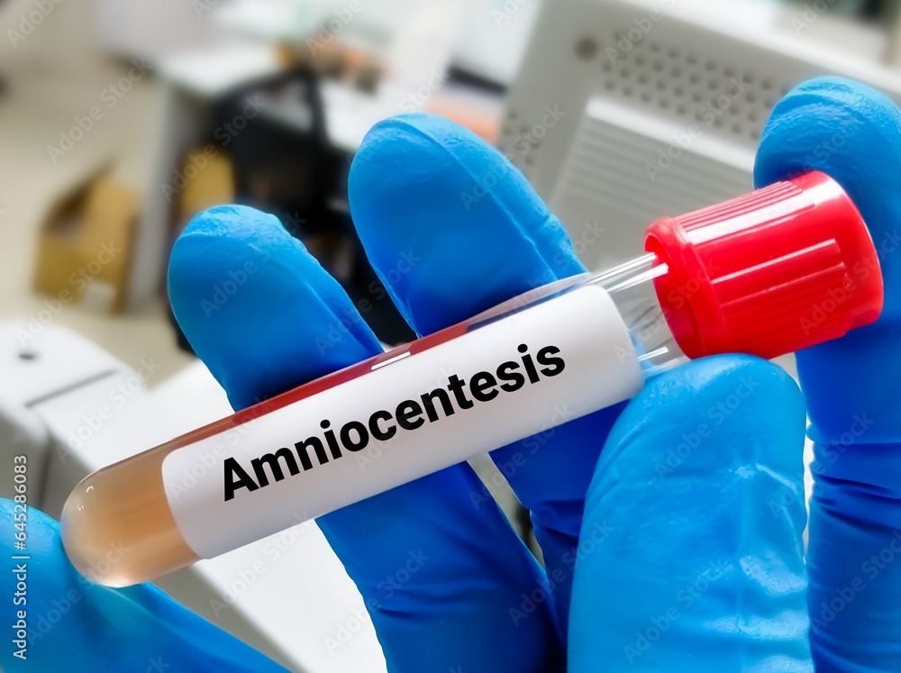 Amniocentesis (amniotic fluid test) a test done during pregnancy (15 to