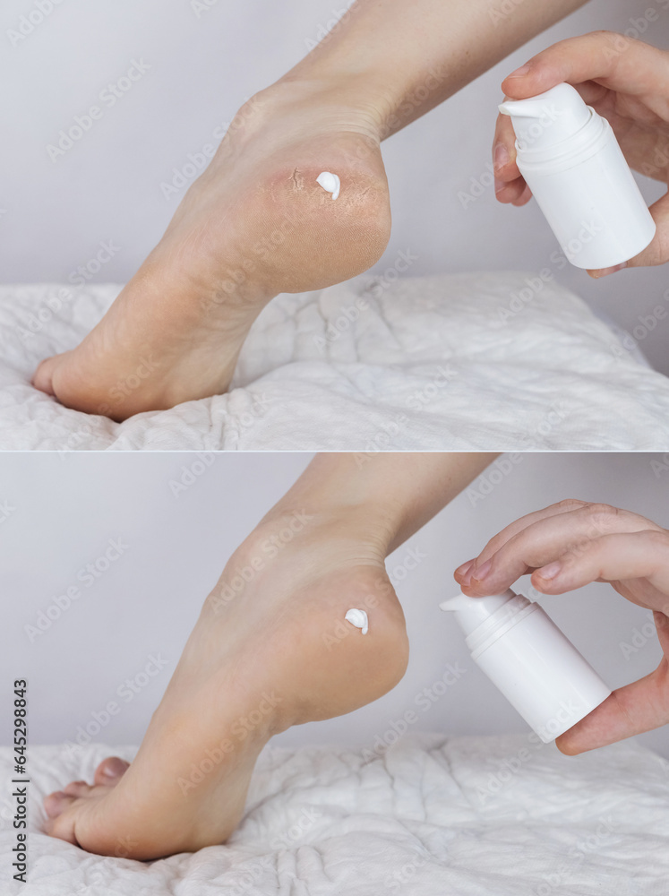 Cracked heels. Woman feet before and after procedures to soften rough