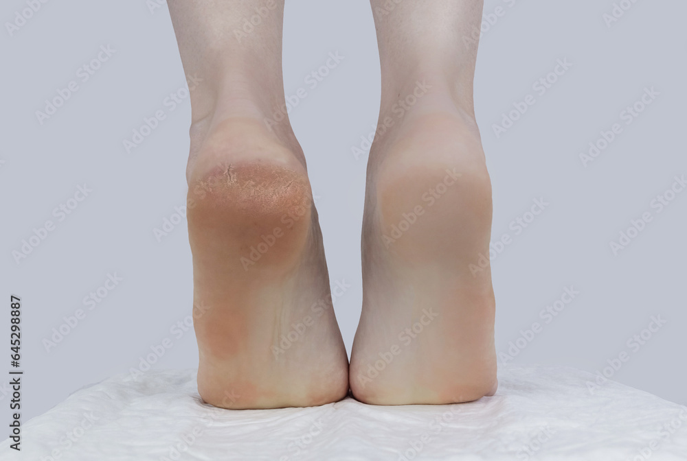 Cracked heels. Woman feet before and after procedures to soften rough