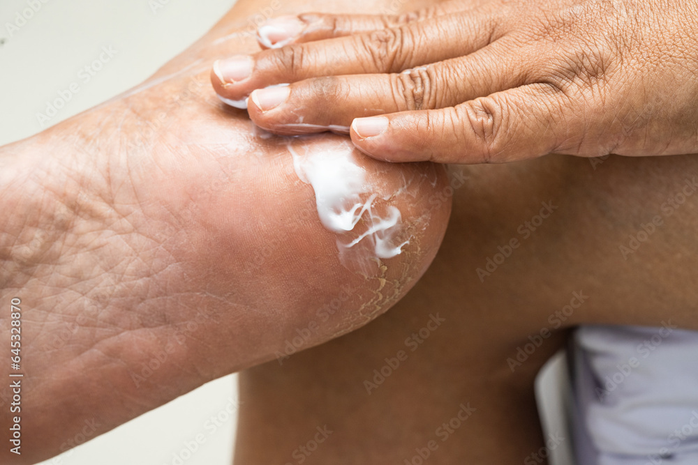 Woman care feet with cracked and dry heel skin cream at home. Woman care feet with cracked and dry heel skin cream at home.