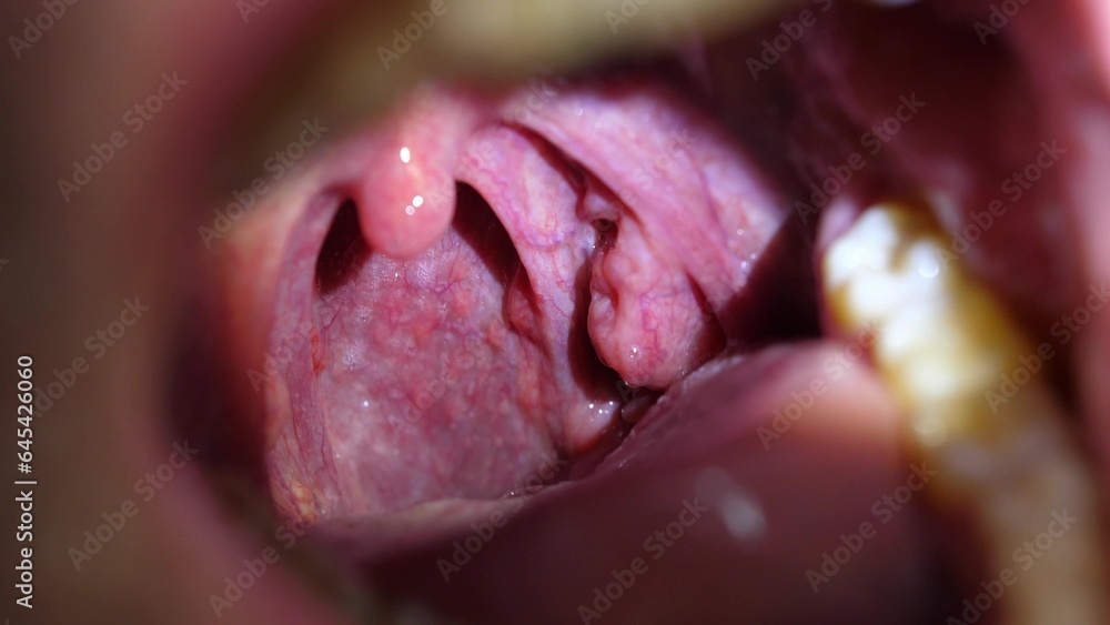 Obraz premium Patient With Sore Throat Examination of Strep Throat and Adenoids