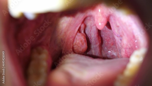 Wallpaper Mural Patient With Sore Throat Examination of Strep Throat and Adenoids Torontodigital.ca