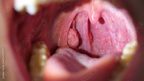 Patient With Sore Throat Examination of Strep Throat and Adenoids photo
