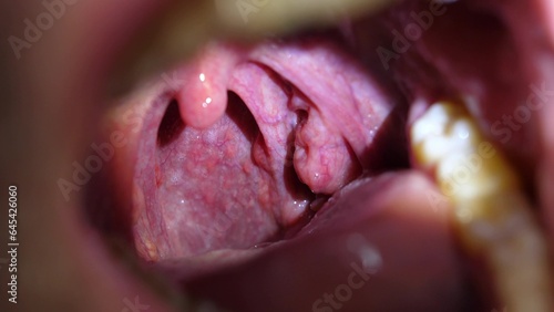 Wallpaper Mural Patient With Sore Throat Examination of Strep Throat and Adenoids Torontodigital.ca