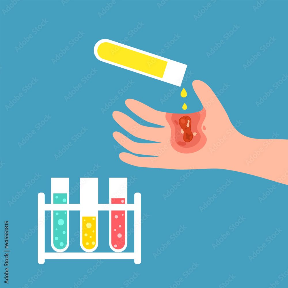Chemical acid burn on hand skin in flat design. Injured palm skin.