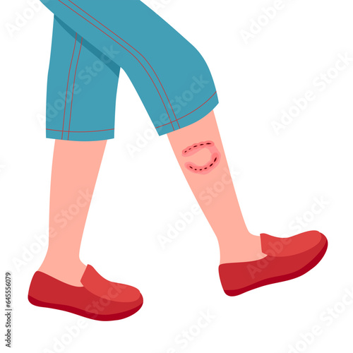 Dog bite mark on leg in flat design on white background.