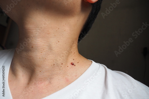 Many skin tags or Acrochordon on the neck of an Asian male. They are small soft and common benign on the human skin especially on adult skin and can be irritated by shaving and daily clothing