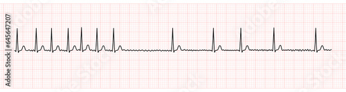 EKG Monitor Showing Atrial Fibrillation With Rapid Ventricular Response and Slower Rate After Adenosine Intravenous