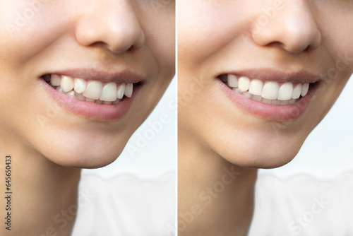 Young woman s smile before and after teeth straightening. Ideal  beautiful shape of teeth after installation of veneers or braces. Whitening. Patient at dental orthodontic clinic.
