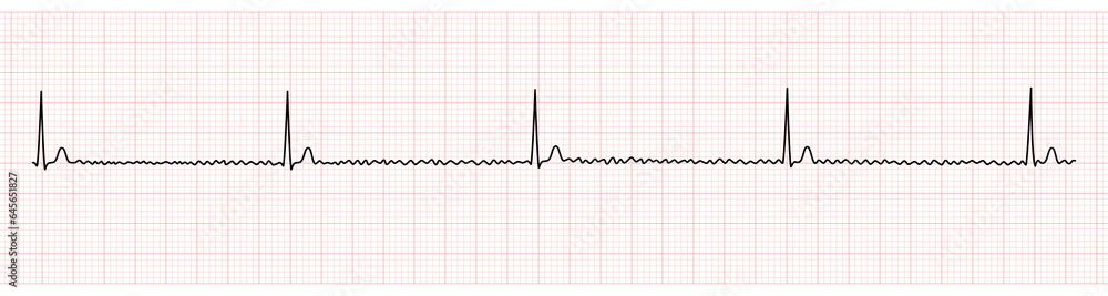 EKG Monitor Showing Regularized Atrial Fibrillation or AF with Block