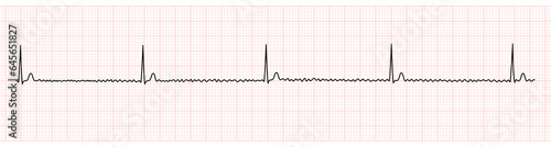 EKG Monitor Showing Regularized Atrial Fibrillation or AF with Block