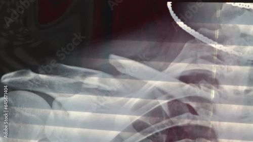 X-ray image showing a broken clavicle bone. An injured shoulder in a man. A close-up video of a post-x-ray image photo
