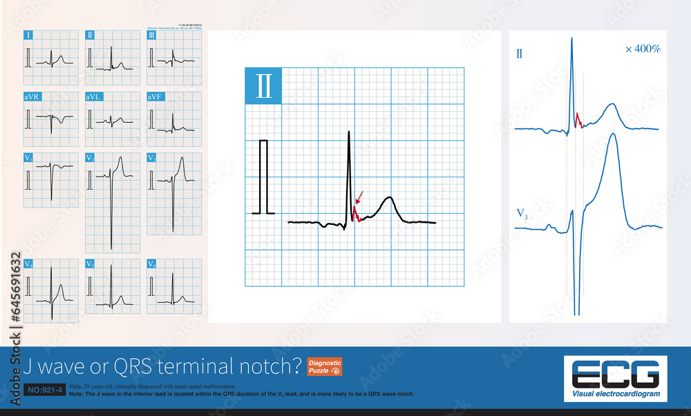 Male, 29 years old, preoperative ECG. Synchronous analysis found that the so-called J wave of lead II was located within the QRS interval of lead V3, and was more likely to be a QRS terminal notch. Male, 29 years old, preoperative ECG. Synchronous analysis found that the so-called J wave of lead II was located within the QRS interval of lead V3, and was more likely to be a QRS terminal notch.