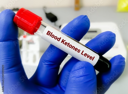 Blood sample tube for ketone test, diagnosis for diabetic ketoacidosis photo
