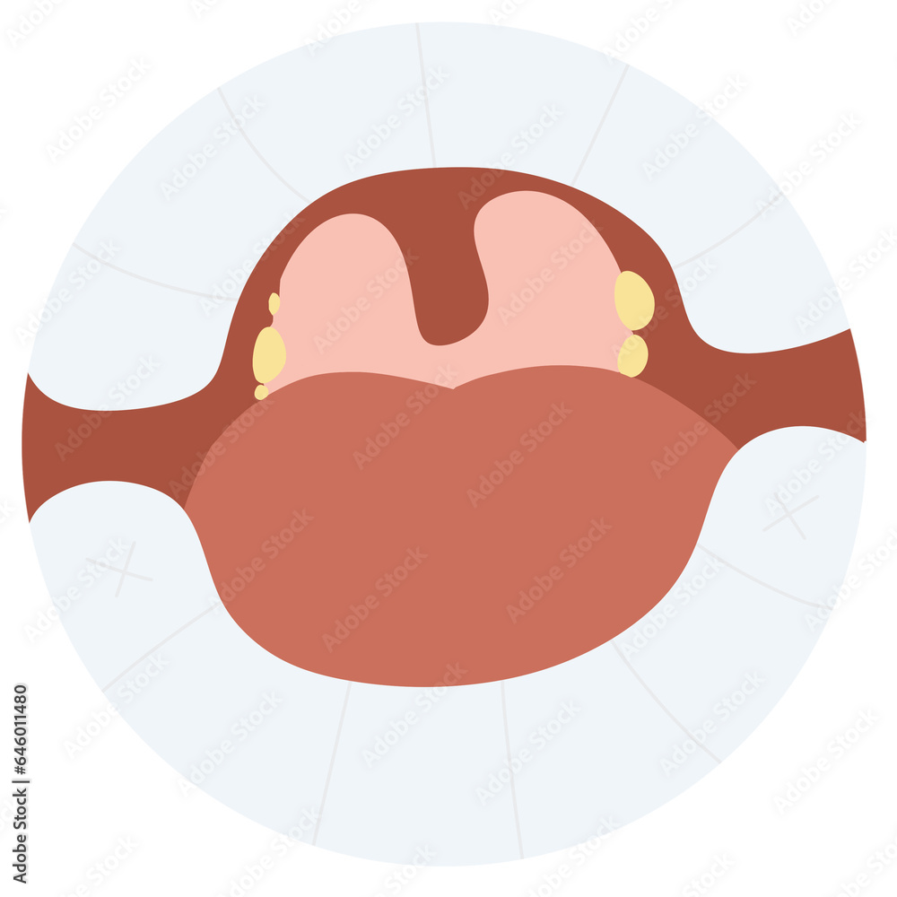 Tonsil Stones crypts viral virus gland strep throat sore enlarged lymph