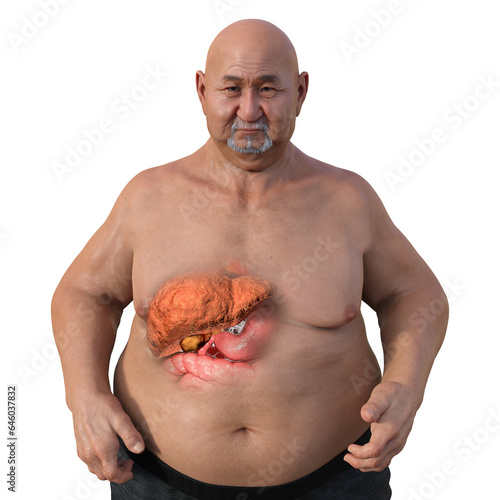 An overweight man with liver steatosis, 3D illustration photo