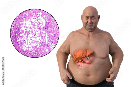 An overweight man with liver steatosis, 3D illustration
