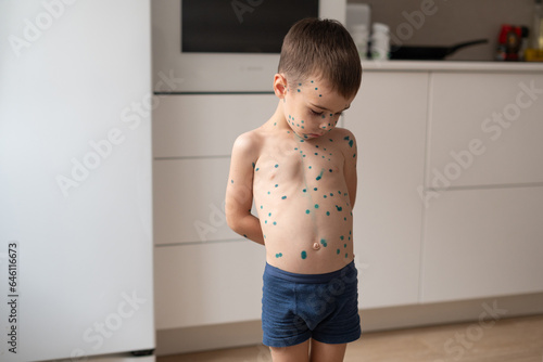 Fotografie The boy points his finger at the spots on the skin that is cured with brilliant green antiseptic