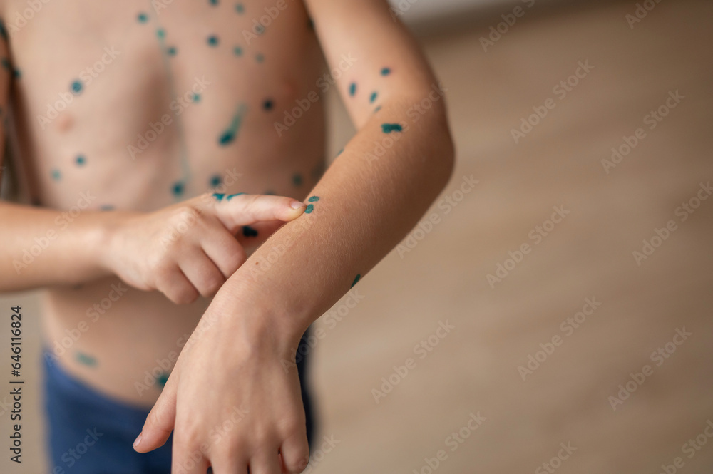 The boy points his finger at the spots on the skin that is cured with brilliant green antiseptic. Chickenpox or varicella zoster virus. Treatment with brilliant green The boy points his finger at the spots on the skin that is cured with brilliant green antiseptic. Chickenpox or varicella zoster virus. Treatment with brilliant green