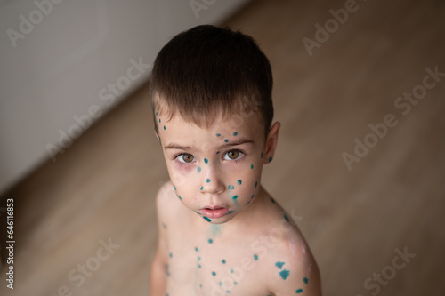 A close-up portrait of a boy whose face is covered with pimples of chickenpox anointed with green paint. Virus. Quarantine. Kindergarten